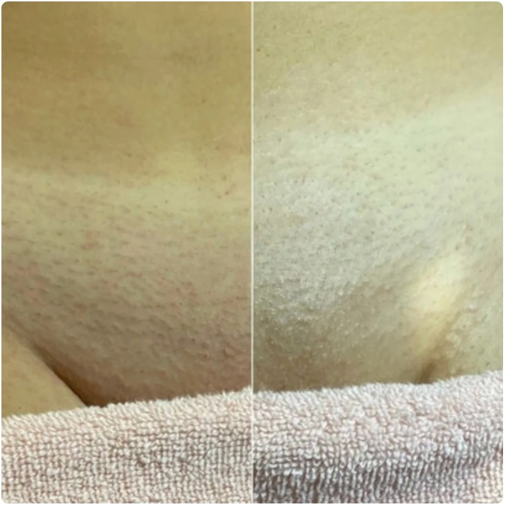 Siero Botanico Anti-Ricrescita