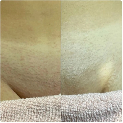 Siero Botanico Anti-Ricrescita